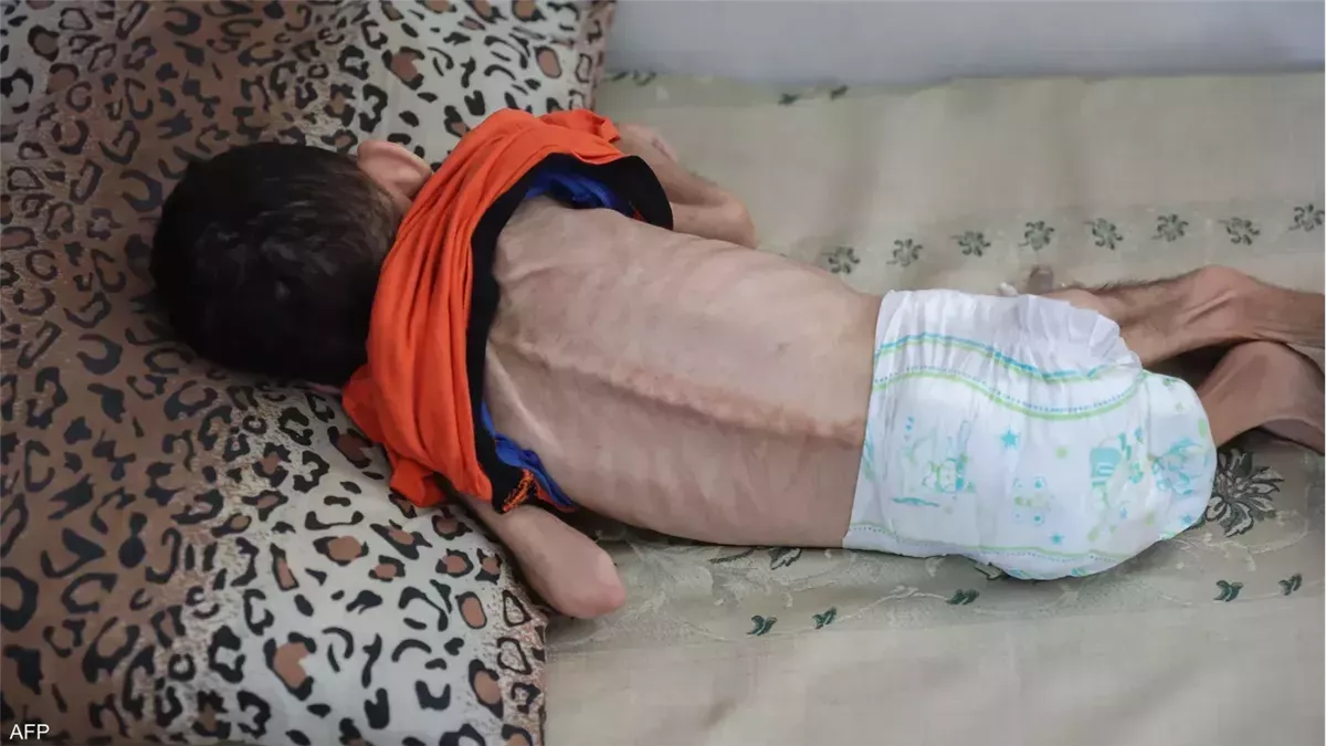 المجاعة تضرب سكان غزة.. زيادة عدد الضحايا إلى 269 فلسطينيًا